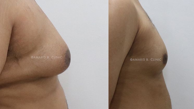 Adolescent gynecomastia Diagnosis for teenagers with gynecomastia