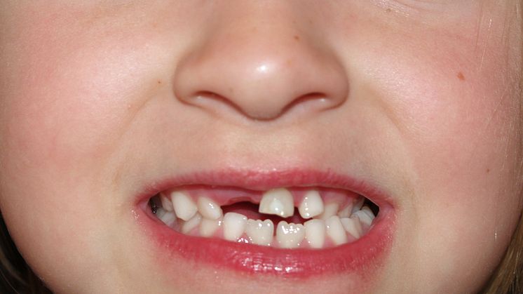 Stora skillnader mellan små barns tandhälsa - MP-förslag ska vända utvecklingen