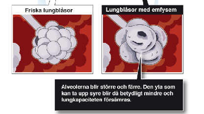 Fyra av fem KOL-drabbade saknar diagnos