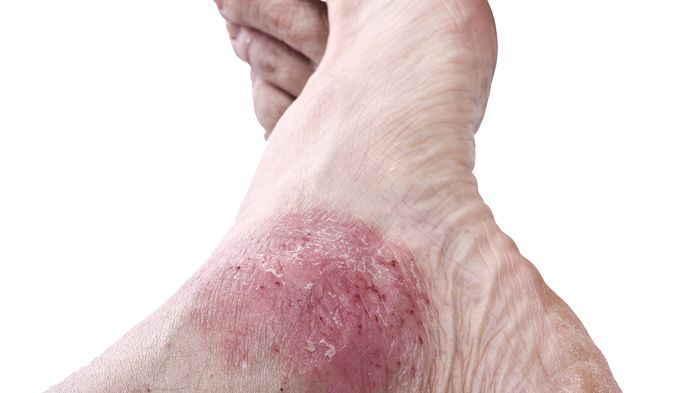 Oftmals liegen mehrere Jahre zwischen dem Auftreten einer Psoriasis (Schuppenflechte) und dem Hinzukommen der Psoriasis-Arthritis. Bild: Orlando Bellini | fotolia