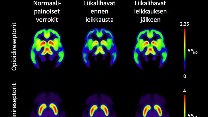 ​Lihavuusleikkauksella aivojen välittäjäaineet tasapainoon