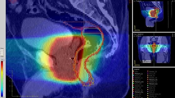 Dosfördelning vid Image Guided Radiotherapy, en metod för preciserad strålning av en prostatacancertumör (Foto: Anders Widmark). 