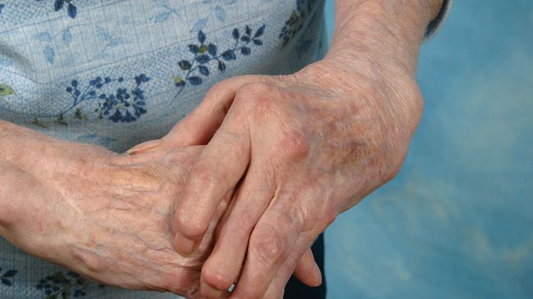 Felställningar i händer vid reumatoid artrit 