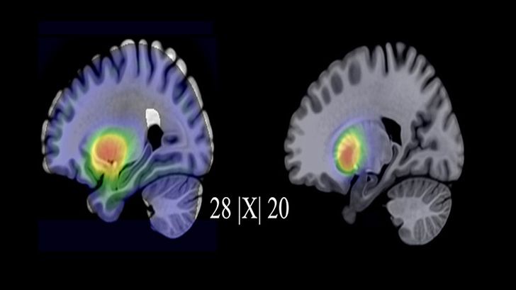 Till vänster serotonin- och höger dopamintransportörbindning före behandling.