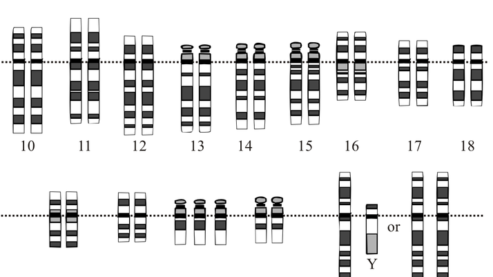 Downs syndrom karyotyp - från Wikimedia