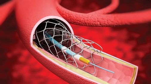 Illustration of a thrombectomy. CREDIT: Stroke Association