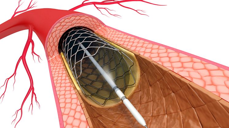 Ballongvidgning med stent