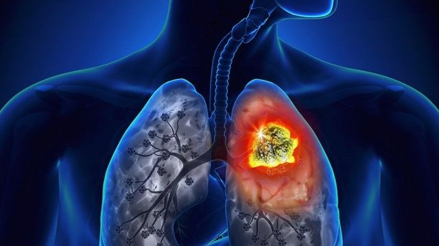 radon lung cancer