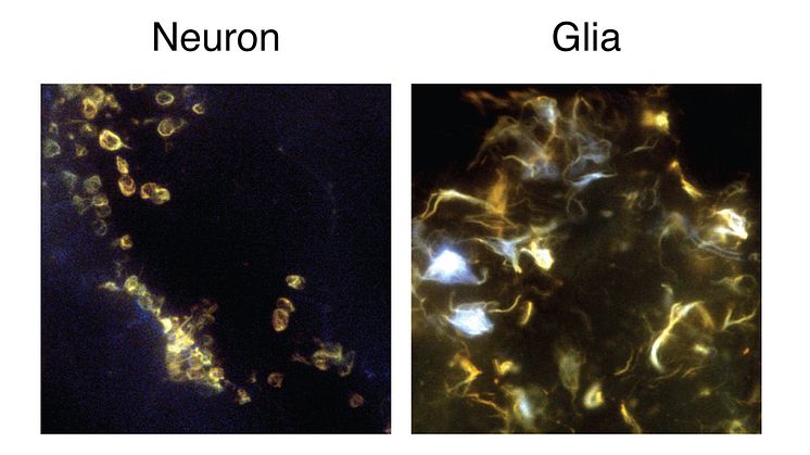 I nervceller, eller neuron, dominerade omogen form av amyloid-beta-fibriller (ringformade i gult) medan gliaceller bildade mer mogen struktur av amyloid-beta-fibriller (spetsiga i gult och även i cyanblå färg).