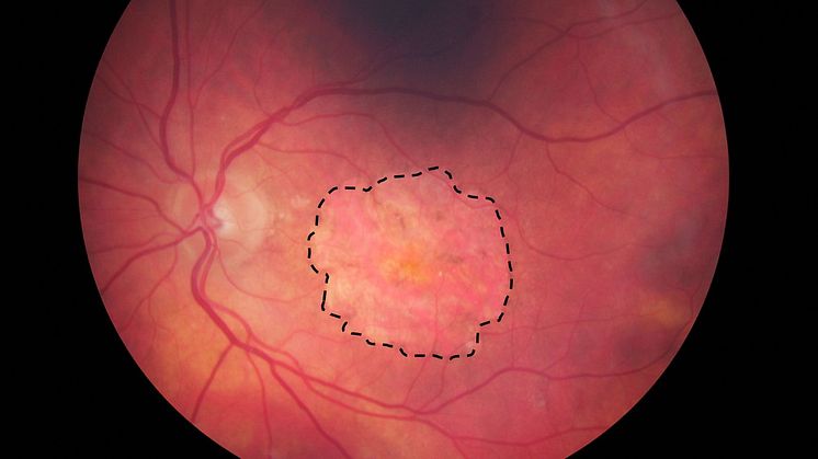Avancerad torr AMD med geografisk atrofi. Den svarta markeringen visar området med celldöd. Foto: S:t Eriks Ögonsjukhus