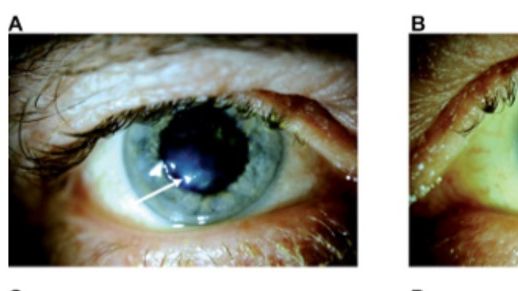 Två exempel på ögon som på grund av den ärftliga ögonsjukdomen fått ärrbildning och inlagringar på hornhinnan (indikerat på bild med pilar) . Bild: Berit Byström.