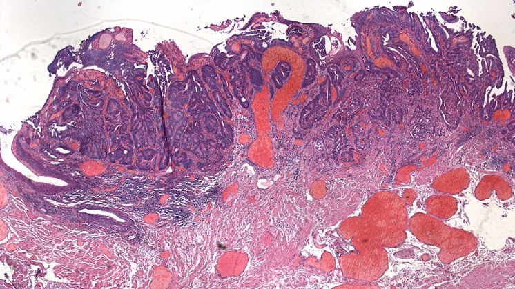 Rektumkarzinom - Malignitätsgrad 1 (histologisches Foto)