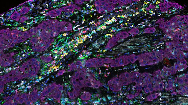 Mikroskopbild av mänsklig tumörvävnad (magentaröd) och olika immunceller som T-celler (gröna och röda) B-celler (gula) och NK-celler (vita). Kornblått markerar aktiverade T- och B-celler. Mörkare blått visar cellkärnor. Foto: Iliana Kyriaki Kerzeli