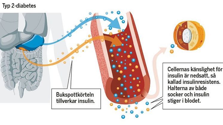 Diabetes uppmärksammas i ny kampanj av Hjärt-Lungfonden