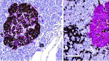 Bilden är tagen ifrån studien: Insulitis in human diabetes: a histological evaluation of donor pancreases.