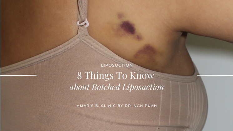 8 Things To Know About Botched Liposuction