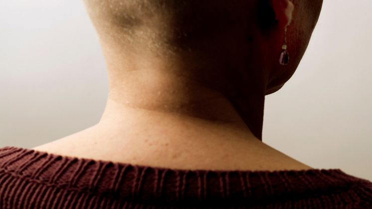 För de som drabbas av sjukdomen alopecia areata kan det dröja månader eller år innan håret växer tillbaka. Foto: Johnér Bildbyrå