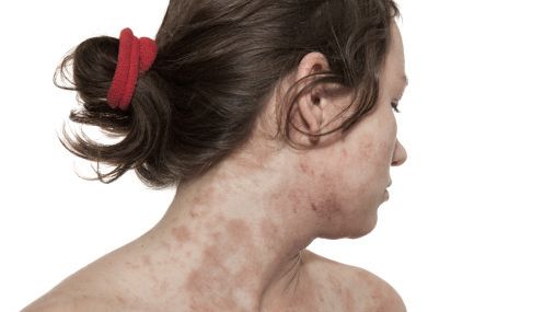 Alvorlig atopisk dermatitt 