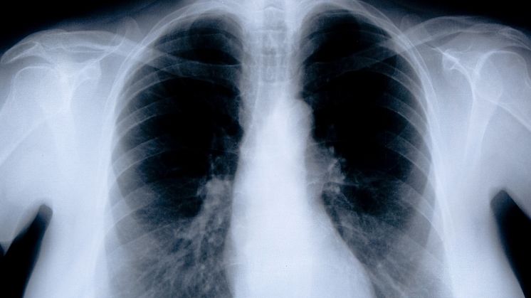 Kort utredningstid i Dalarna vid misstänkt lungcancer