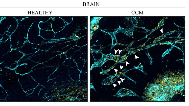 Blodkärl i hjärnan. Till vänster: endotelceller (turkosblå) från en frisk hjärna. Till höger: vid kavernöst angiom delar sig endotelceller (kärnor i gult) i venerna snabbare och orsakar missbildningar. Foto: Fabrizio Orsenigo