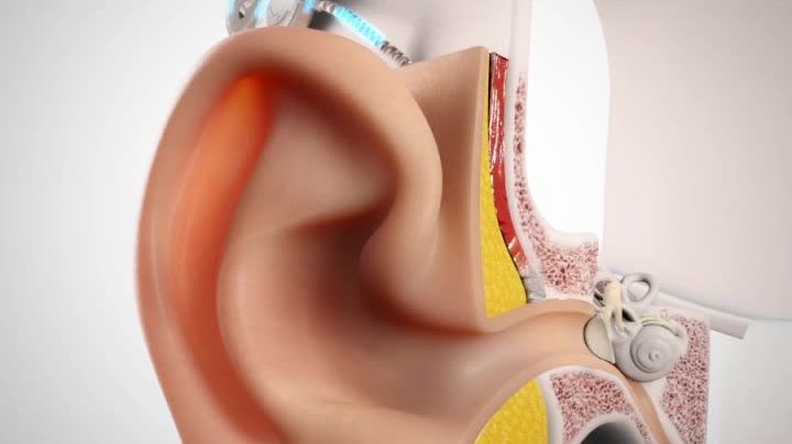 Wie funktioniert ein Cochlea-Implantat?