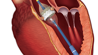 Kateterburen klaffimplantation är ett alternativ för patienter med aortastenos som är för gamla eller sjuka att genomgå en vanlig hjärtklaffoperation. Illustration: Edwards Life Sciences.