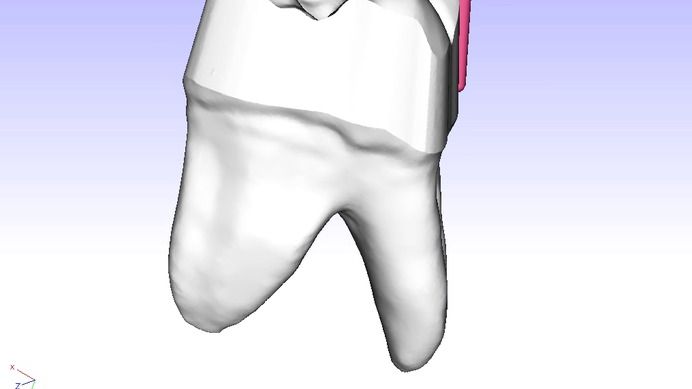 Virtual grinding of the tooth