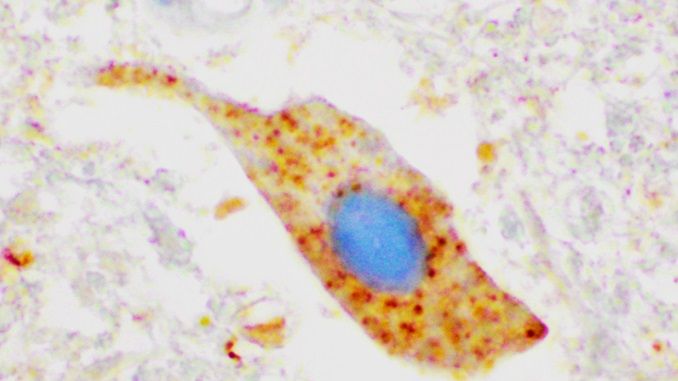 Proteinklumpar i mikroskop