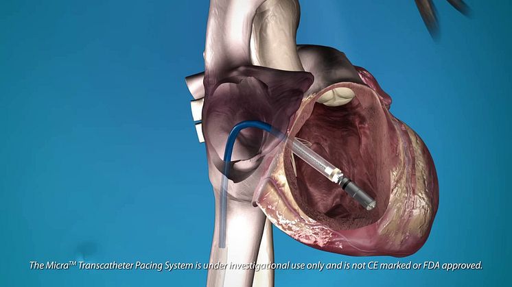 Micra™ Transcatheter Pacing System (TPS)
