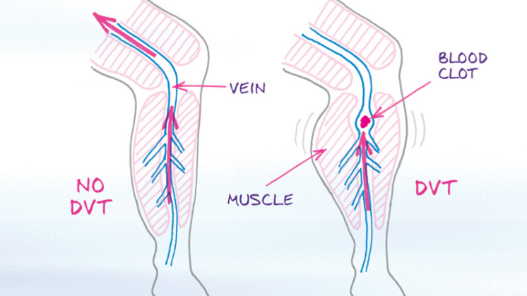 DVT, blodpropp i benet. Illustration