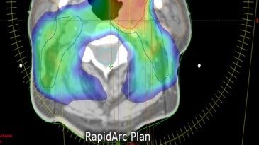 Ett tvärsnitt ur en strålbehandlingsplan för en patient med huvud- och halscancer. Bild: Varian Medical Systems.