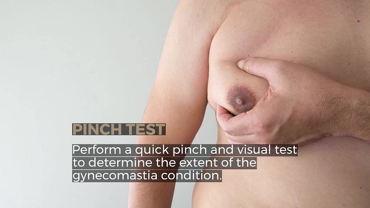 Gynecomastia Diagnosis: How to do a DIY physical assessment to find out if you have gynecomastia