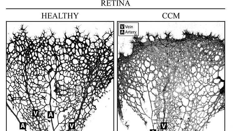 CCM retina