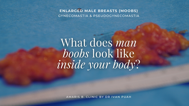 What does man boobs look like inside your body?