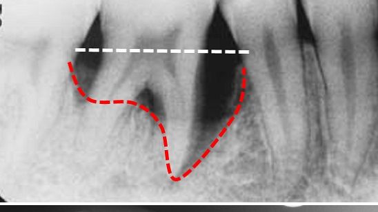 Normala käkbennivån (vit linje) vid en kindtand i underkäken och tandens förlorade käkbensstöd (röd linje) vid tandlossning. Röda pilar visar typiska bendestruktioner i en fot orsakade av reumatoid artrit. Bilder: P. Lundberg & S. Rantapää-Dahlqvist
