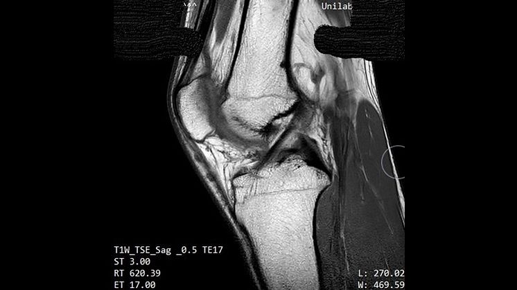 MR-kamerabild av knäled hos 17-årig pojke.