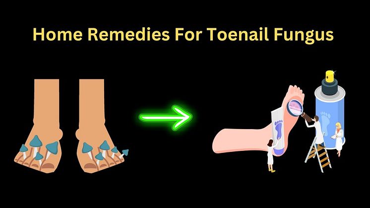 Home Remedies For Toenail Fungus - 17 Easy To Follow Tips So You Can Wear Flip Flops Proudly