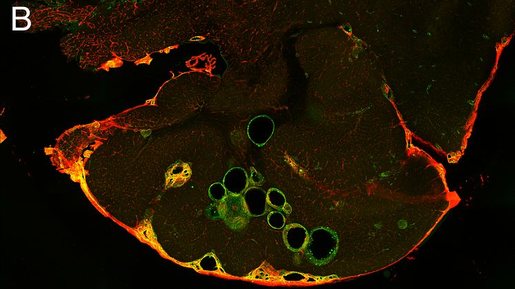 Propranolol treatment contributes to reduced number and size of cerebral cavernous malformations. The lesions are outlined in green. Photo: Joppe Oldenburg