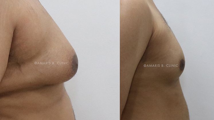 Adolescent gynecomastia: Diagnosis for teenagers with gynecomastia