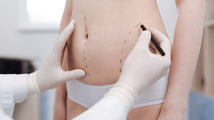 A less invasive form of liposuction : Modern Liposuction With MDC-SCULPT®️ Lipo Technique