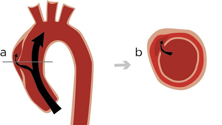 Figuren föreställer en aortabristning i aortas längdaxel (A) och i tvärsnitt (B). Aortas bristning orsakas av att en plötslig spricka i kärlets innervägg leder till att blod strömmar i aortas vägg och försvagar den. Illustration: Mattias Pettersson