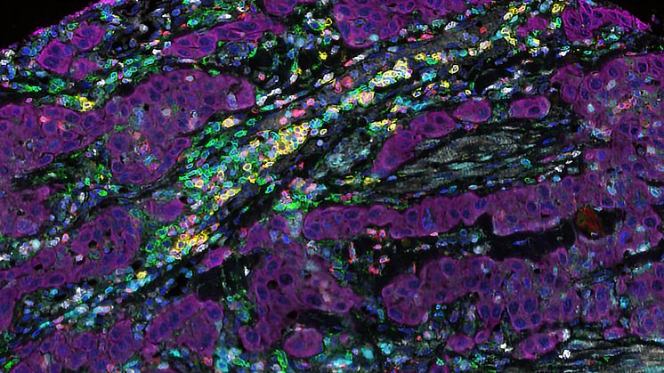 Microscopic image of human tumour tissue and various immune cells. Photo: Iliana Kyriaki Kerzeli