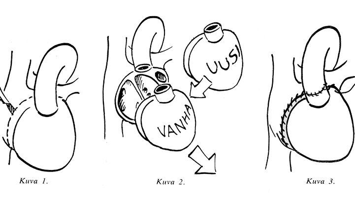 Ensimmäistä sydänsiirtoa havainnollistettiin vuoden 1968 ensimmäisessä Sydämssä oheisen piirrossarjan avulla.