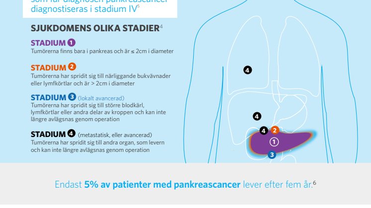 Fakta om pankreascancer  