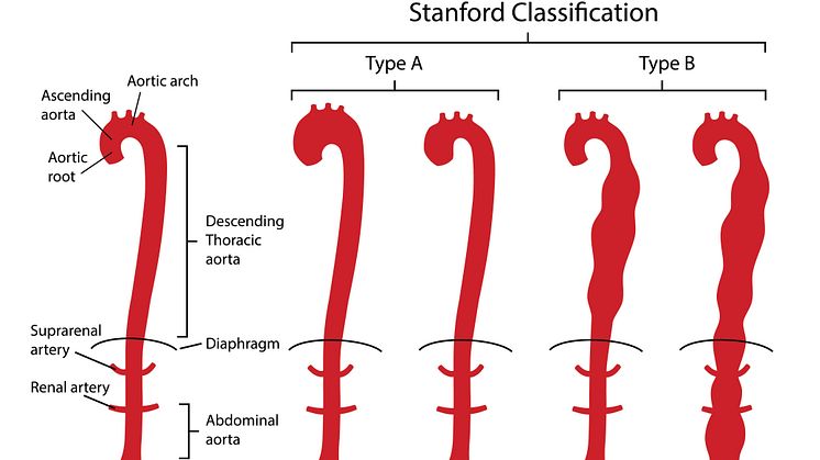 AdobeStock_Gesunde-Aorta-im-Vergleich-mit-Aortendissektion-Typ-A-und-B_Stanford-Klassifikation