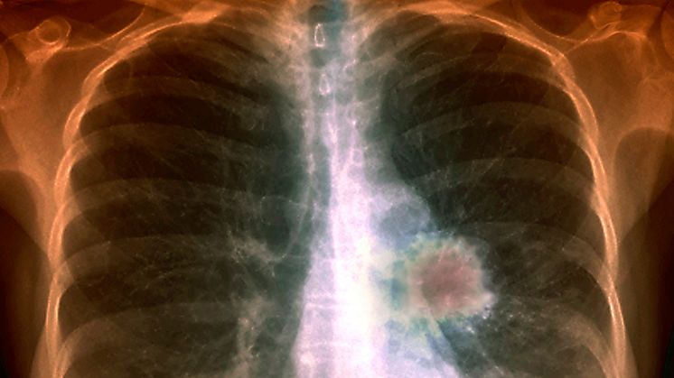 X-ray showing lungcancer