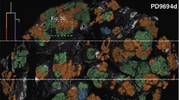Forskare har för första gången i detalj kunnat kartlägga utbredningen av cancerkloner och hur de beter sig. Bilden visar ett lapptäcke av cancerkloner som har färgats blå, orange och grönt. Bild: Artem Lomakin och Lucy Yates.