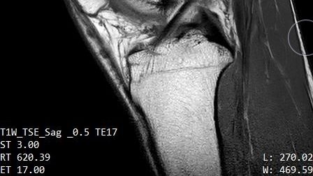 Magnetkameraundersökning av knäled hos en då 16-årig pojke som vet sin födelsedag. Han blev åldersuppskriven med fyra månader för att göras utvisningsbar.