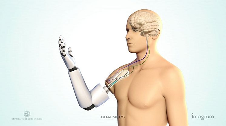 World premiere of muscle and nerve-controlled arm prosthesis