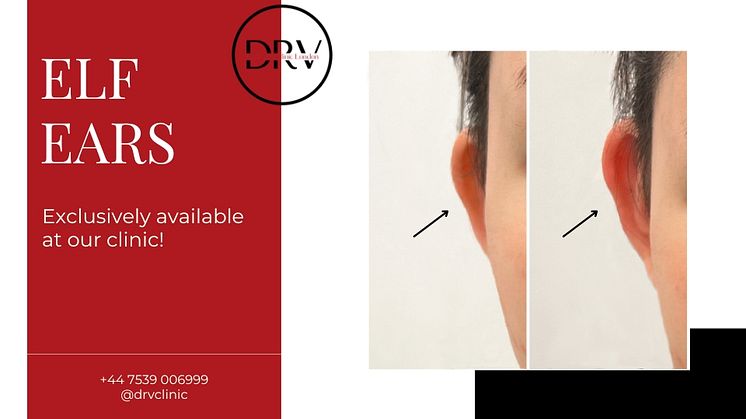 Introducing DRV Clinic's Revolutionary Non-Surgical Elf Ears Procedure: A Blend of Fantasy and Beauty